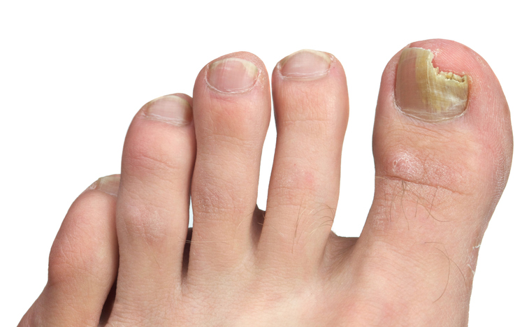mycose-ongle-pieds
